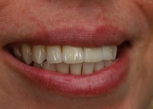 Front casus resultaat Dentix